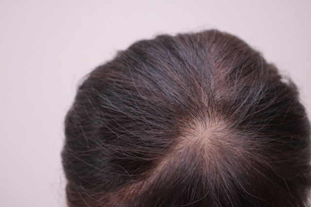 医師監修 つむじはげの基準ってどこから 見分け方や改善対策を解説 Vitabridc12 Hair
