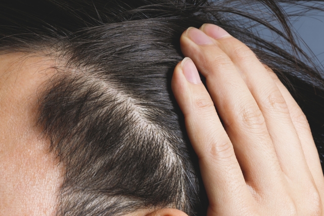 抜け毛がひどいとお悩みの男性 女性必見 原因と対策 図解 美容と健康とビタミンc