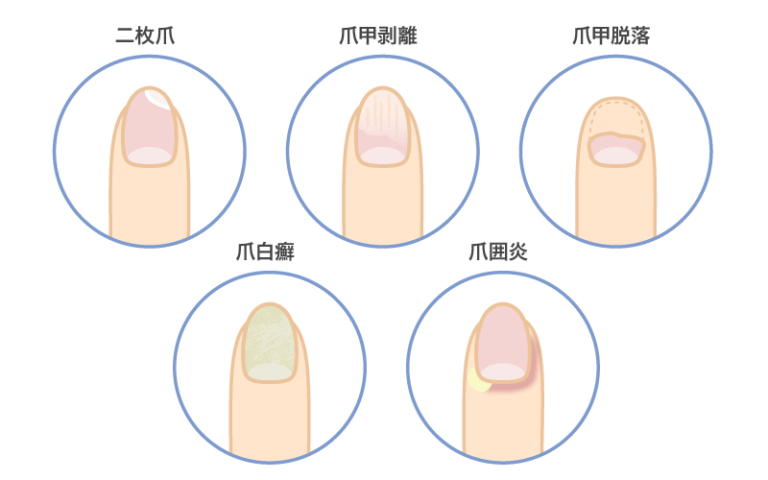【タイプ別診断チャート付き】爪が剥がれる原因と対処法・受診の目安を解説 | 美容と健康とビタミンC