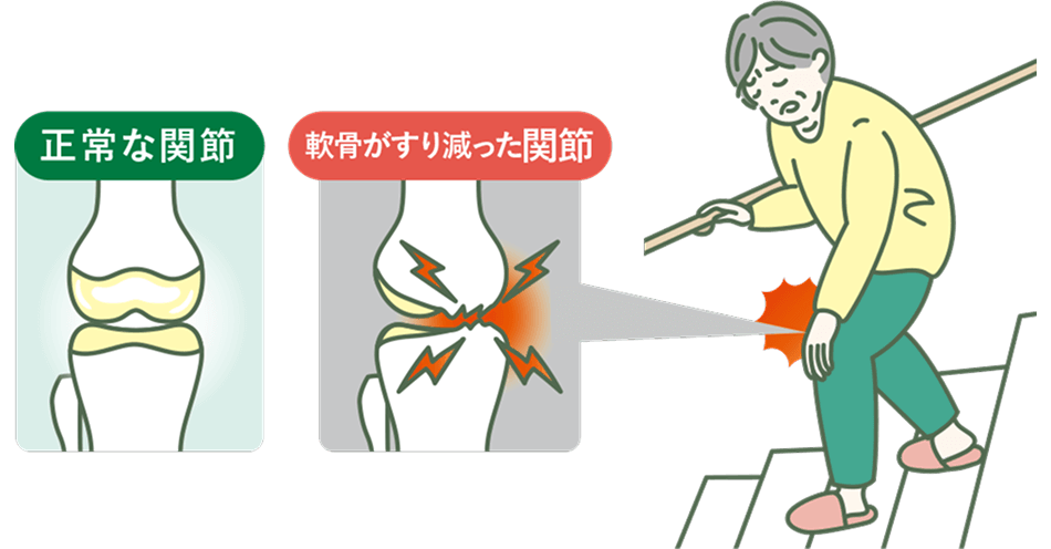 正常な関節と軟骨がすり減った関節
